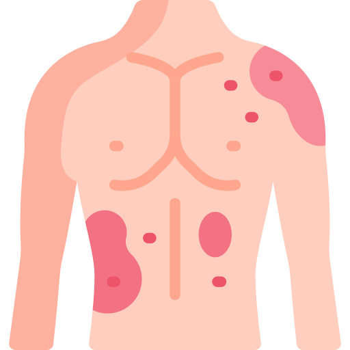 hives