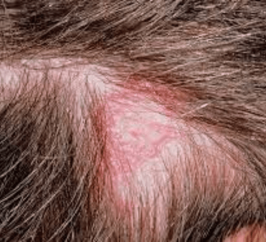 Ringworm 1