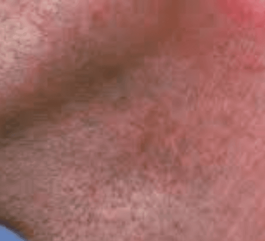 Ringworm 2