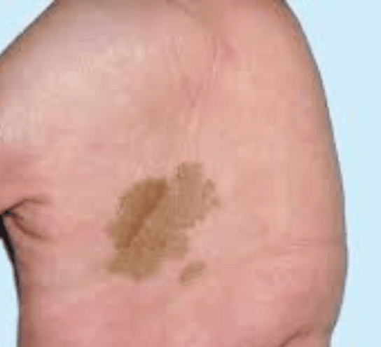 Ringworm 3
