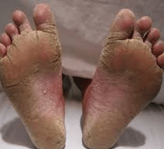 Ringworm