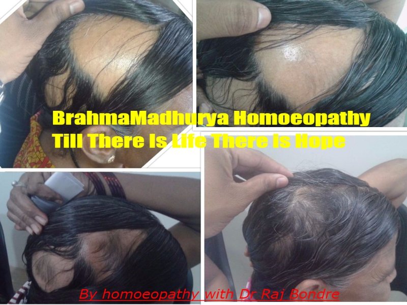 hairfall