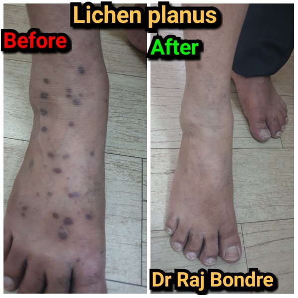lichen planus