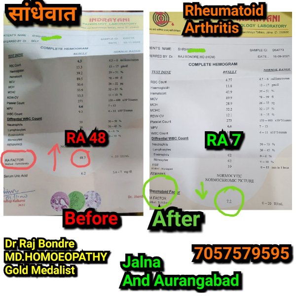 rheumatodi arthritis